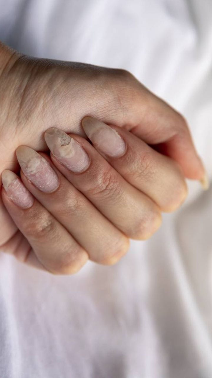 Doenças das Unhas: Como Identificar, Tratar e Prevenir Problemas Comuns